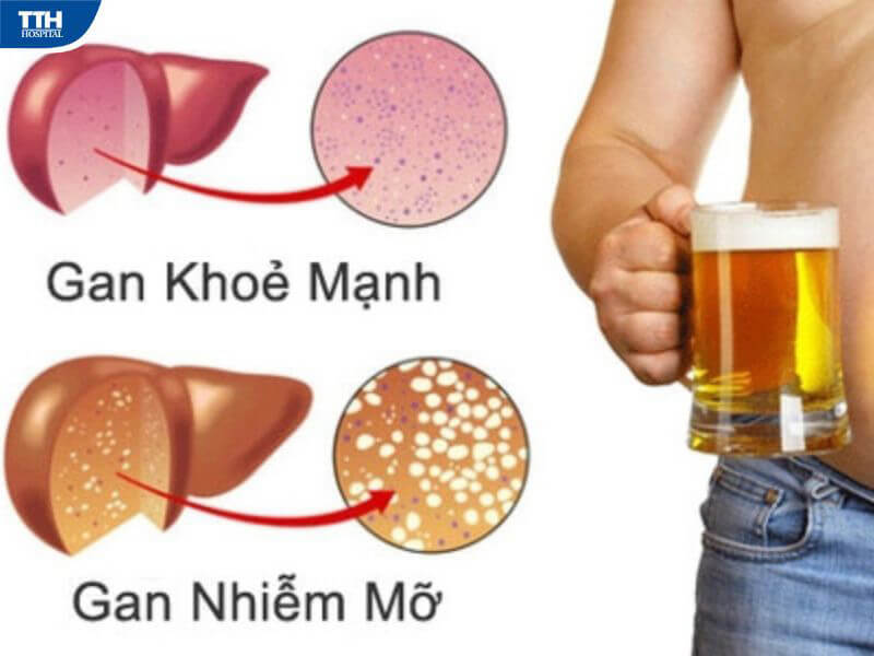 Gan nhiễm mỡ nguy hiểm như thế nào? 