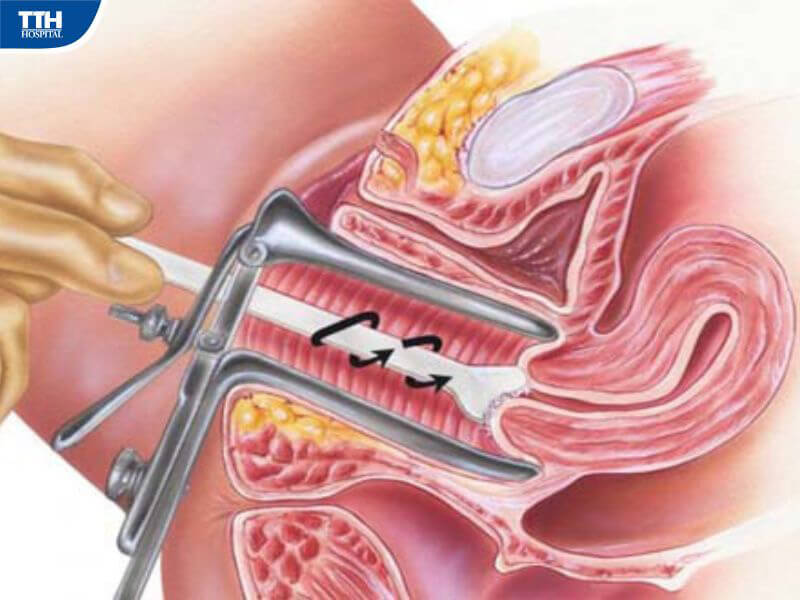 Lợi ích của sàng lọc ung thư cổ tử cung