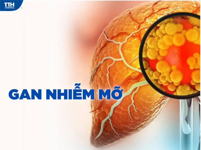 Nguyên nhân gây bệnh gan nhiễm mỡ